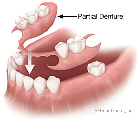 Dentures