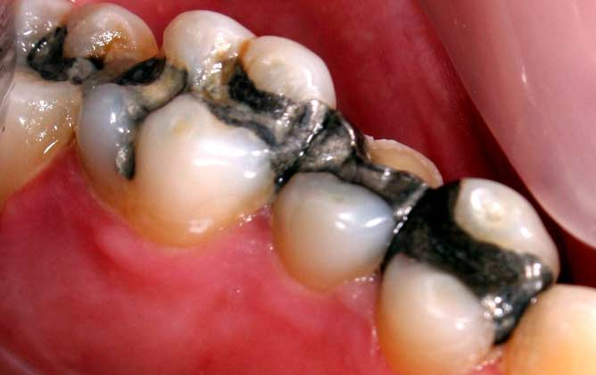 Should You Be Concerned if You Have Amalgam Tooth Fillings?