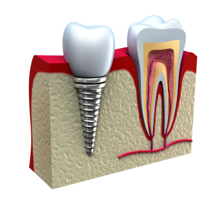 What Are The Major Pros & Cons of Dental Implants?