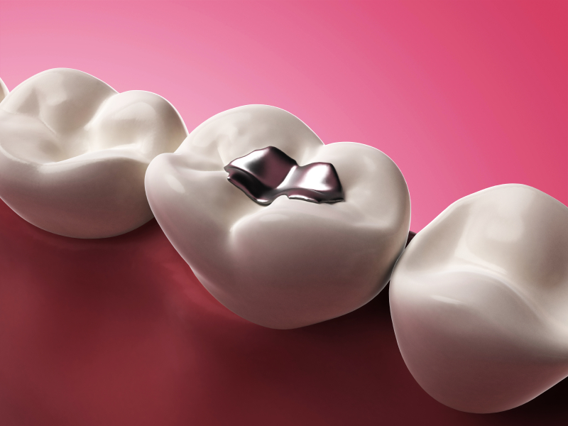 The Pros and Cons Silver & Composite Dental Fillings Northside Family