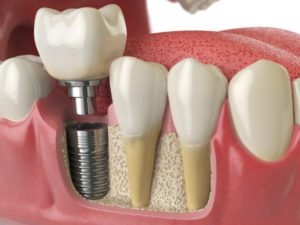 answers to your questions about dental implants