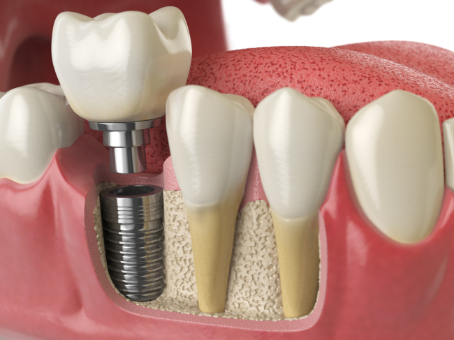 Are Dental Implants Right for Me?