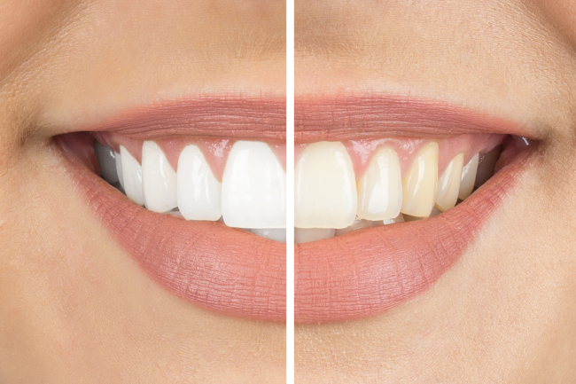 Teeth Whitening Tips and Advice