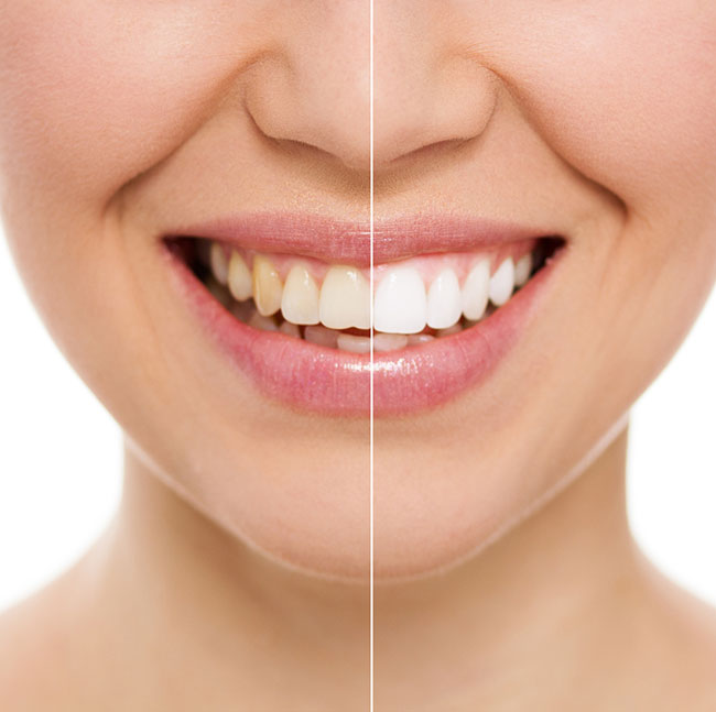 Brighten Your Smile with Teeth Whitening