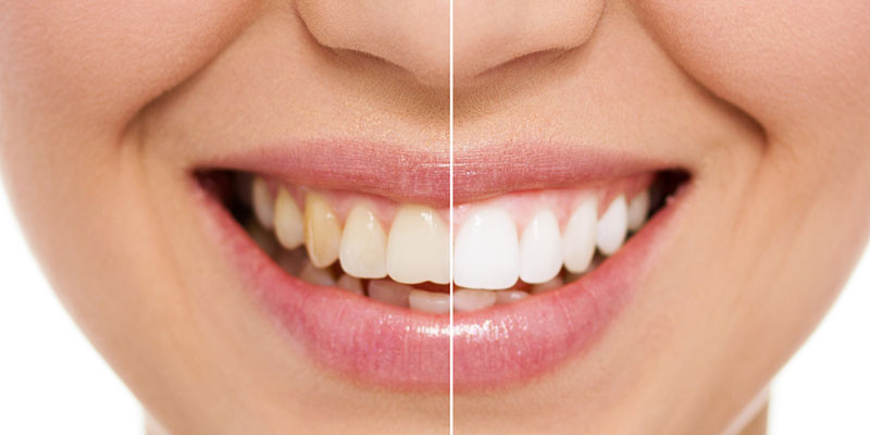 see a dentist for teeth whitening