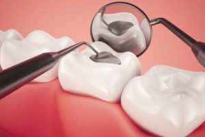 What to Expect When Getting Tooth Fillings