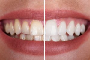 Four Reasons You Will Love Teeth Whitening