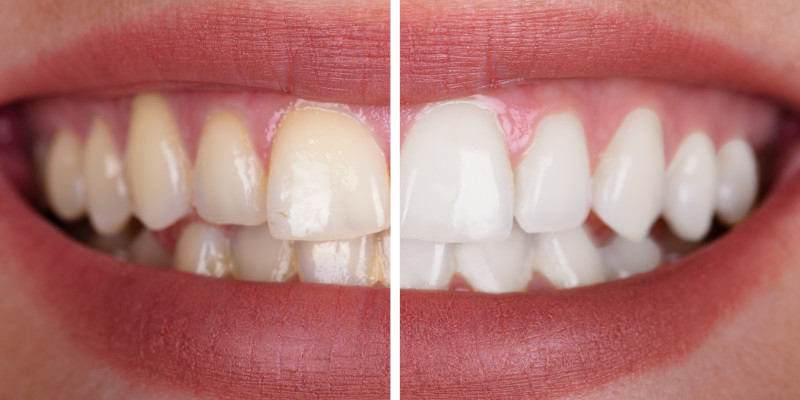 Four Reasons You Will Love Teeth Whitening