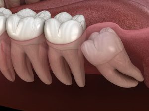 Here’s Why Wisdom Tooth Extraction is Important for Your Oral Health