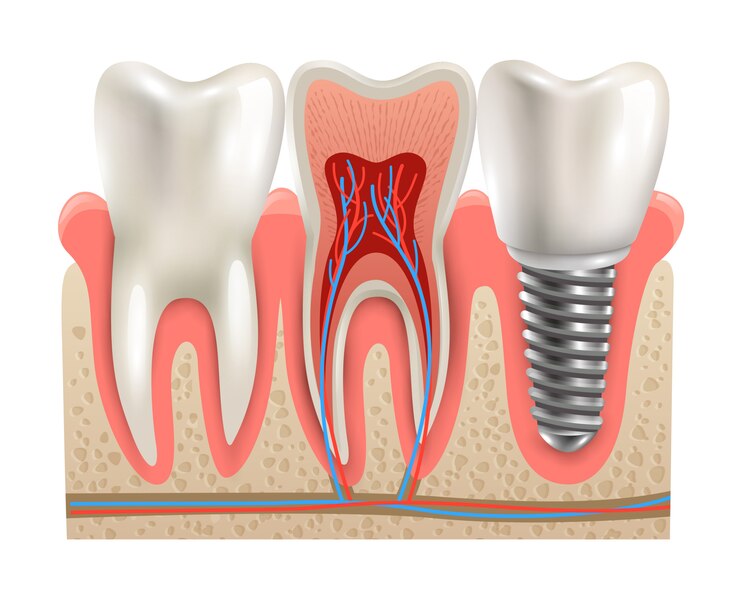 dental implants in Lakeland, FL