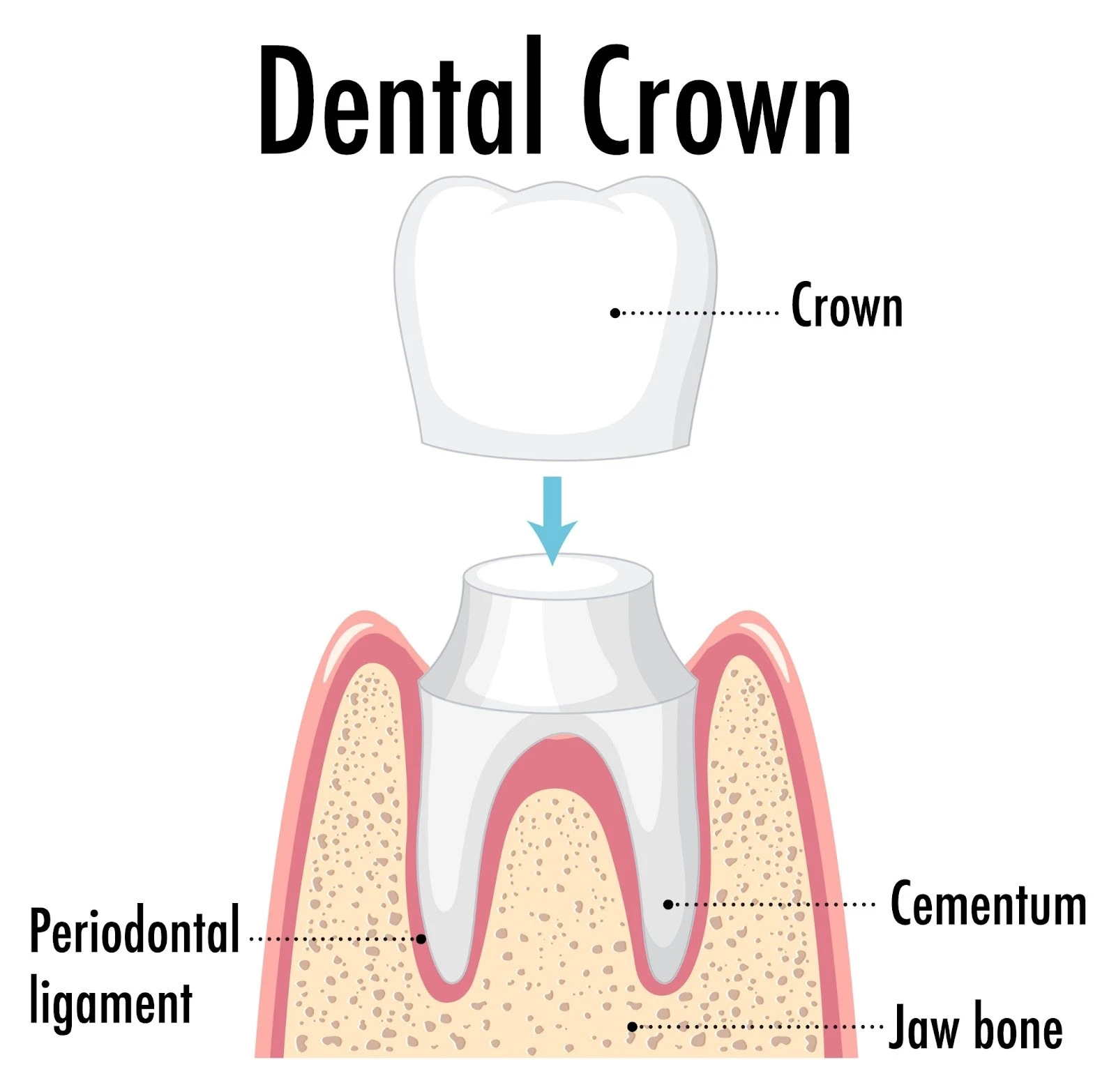 Disadvantages of Dental Crowns: Is It the Right Choice for You?