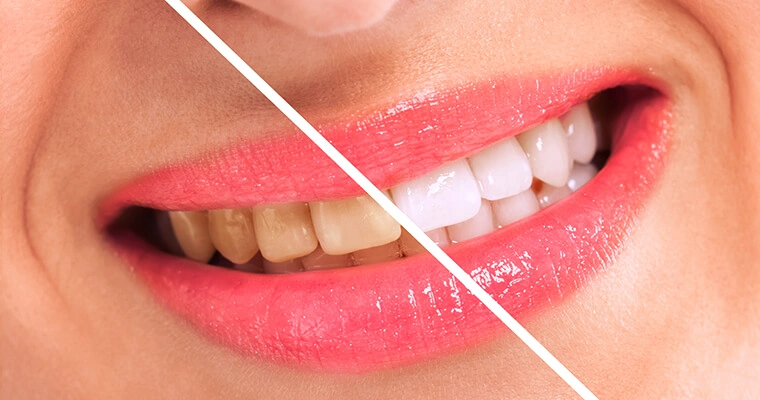 How Long Does Teeth Whitening Last?