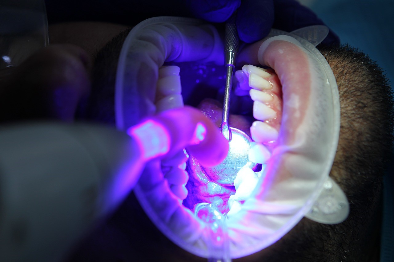 Does Teeth Whitening Damage Enamel?