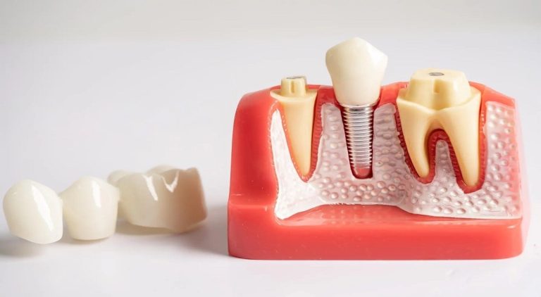 8 Signs That You Need Dental Implants