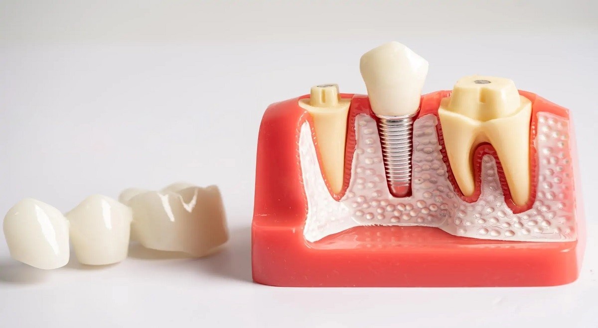 8 Signs That You Need Dental Implants