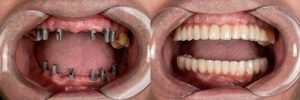 Different Types of Dental Implants