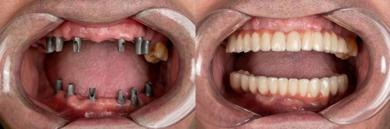 What are the Different Types of Dental Implants?
