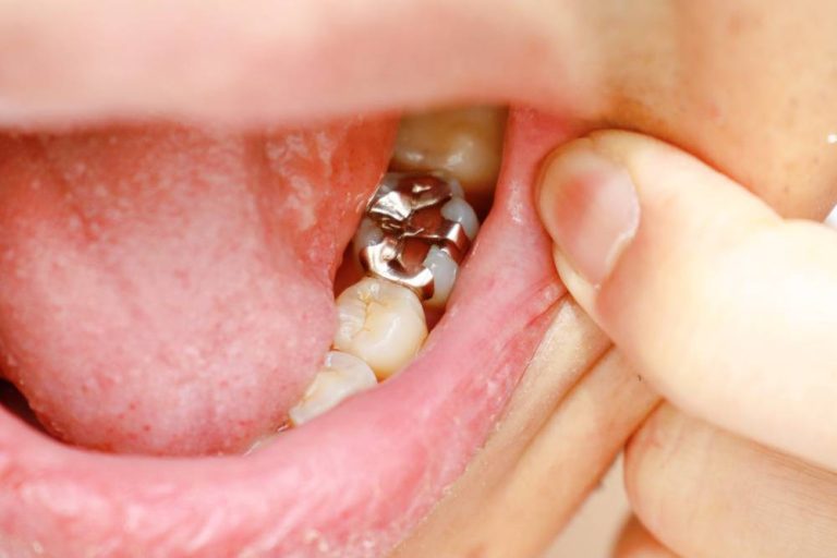 All About Types of Dental Fillings for Teeth and How They Work!