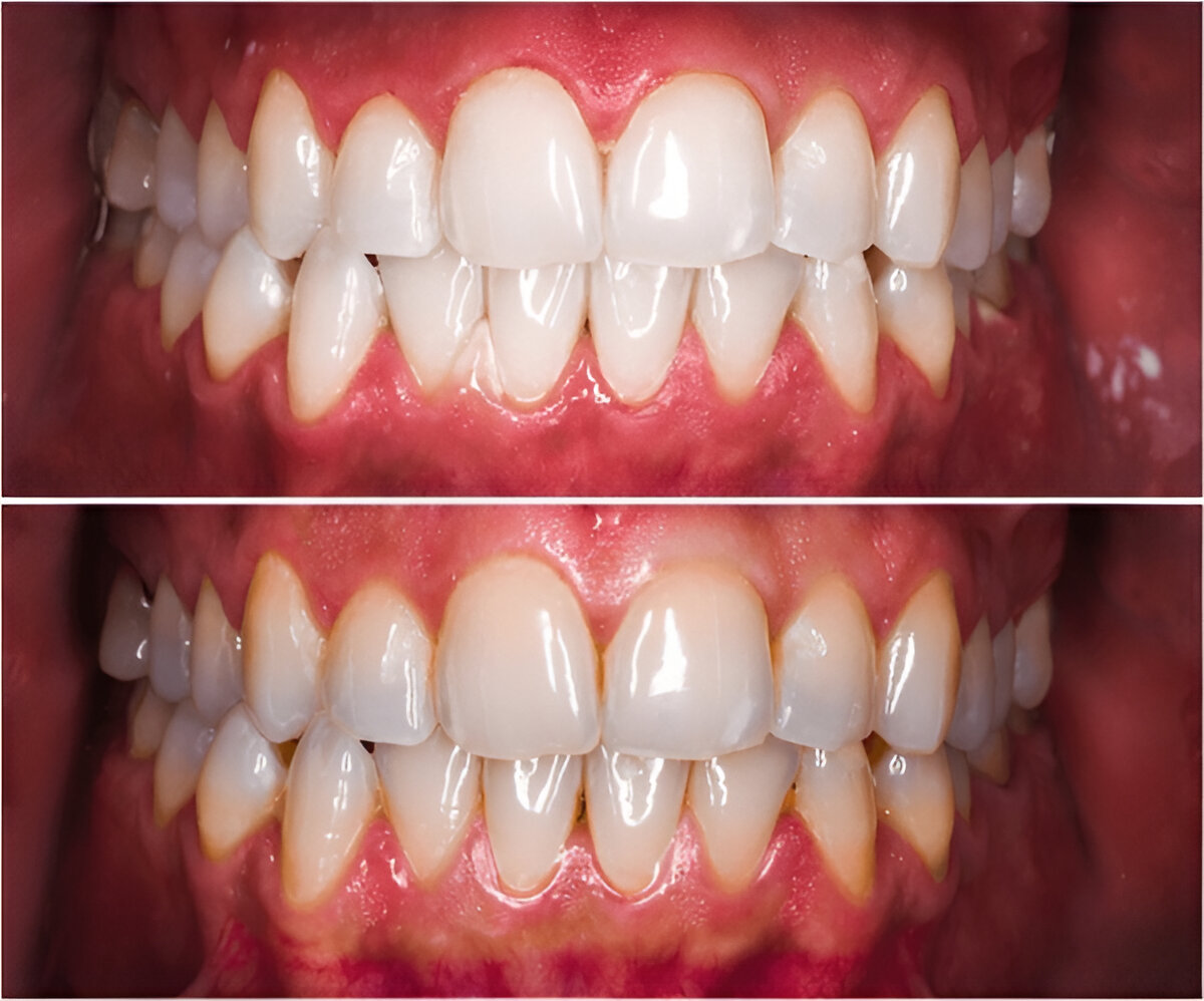 Does Tooth Whitening Peroxide Go Bad? 