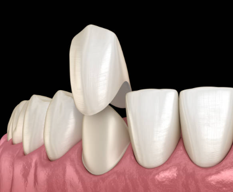 Can Tooth Crowns Be Whitened?