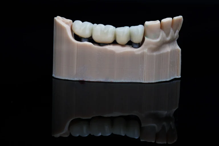 Which Is More Durable: Crowns or Bridges in Lakeland, FL?