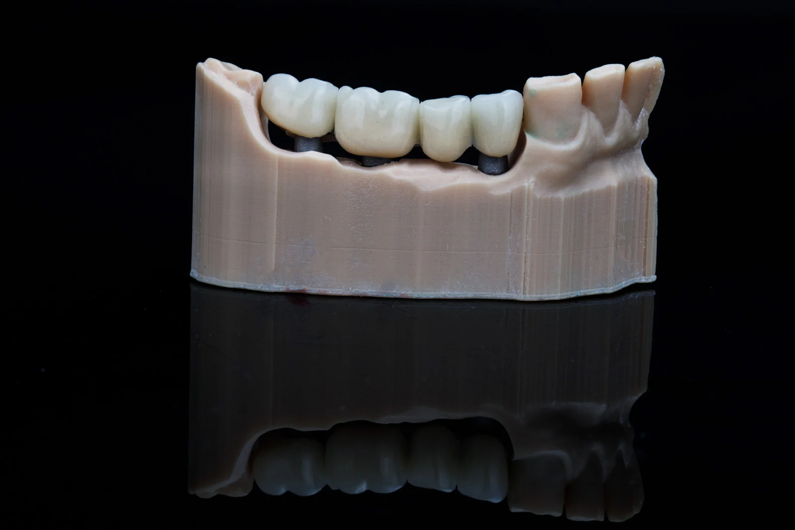 Which Is More Durable: Crowns or Bridges in Lakeland, FL?