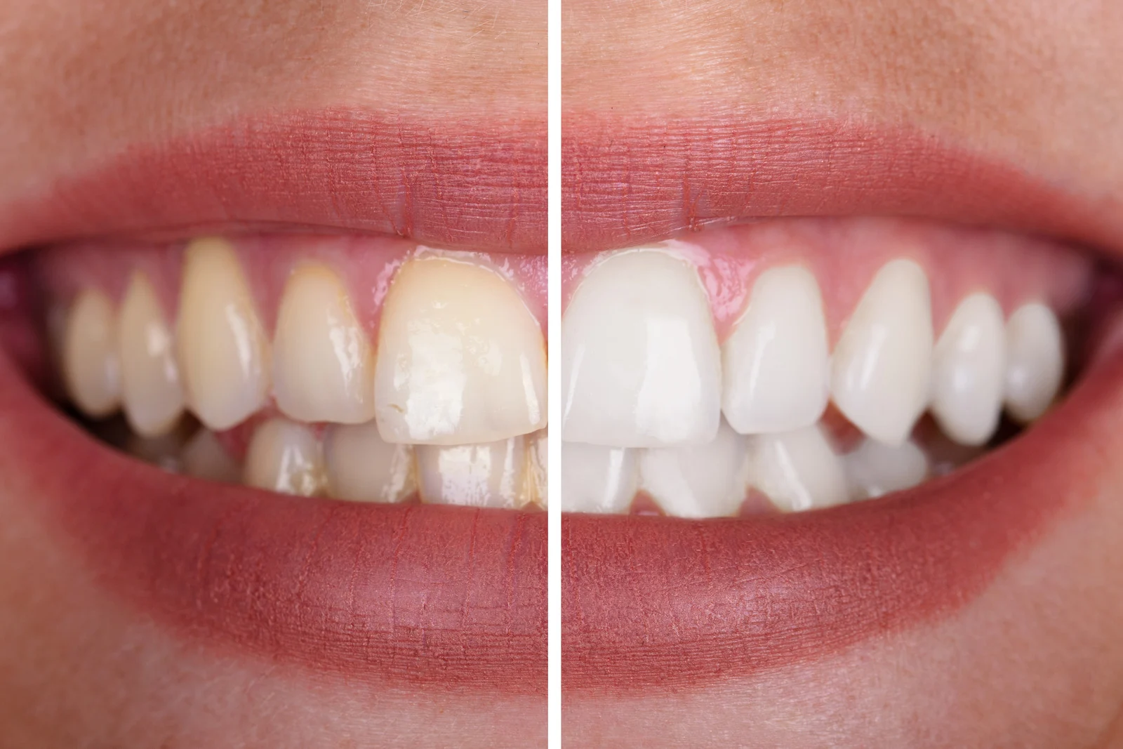 Where Can You Find the Best Tooth Whitening Services in Lakeland, Florida?