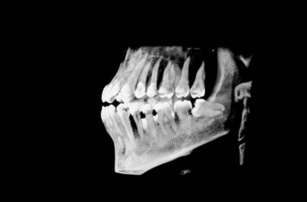 wisdom tooth extraction