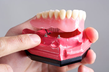 dental implants