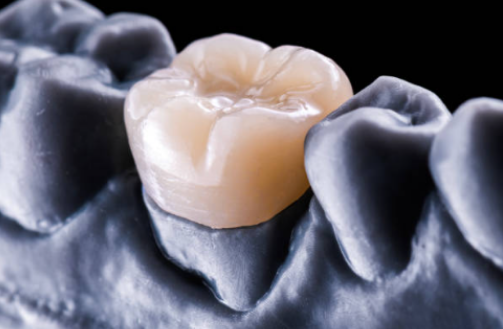 Dental crown cost in North Lakeland, FL, with information about dental crowns, restoration benefits, and treatment options.