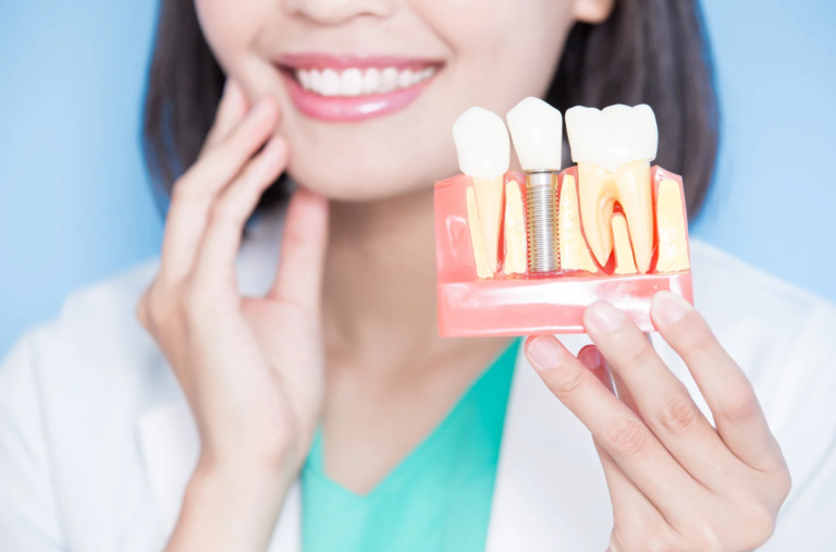 Full Mouth Dental Implants in Lakeland, FL: Complete Guide!