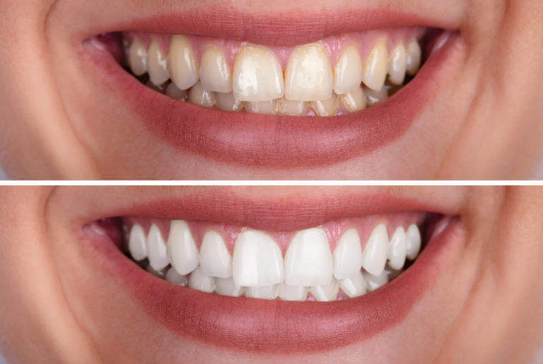 How Much Does Teeth Whitening Cost in Lakeland?