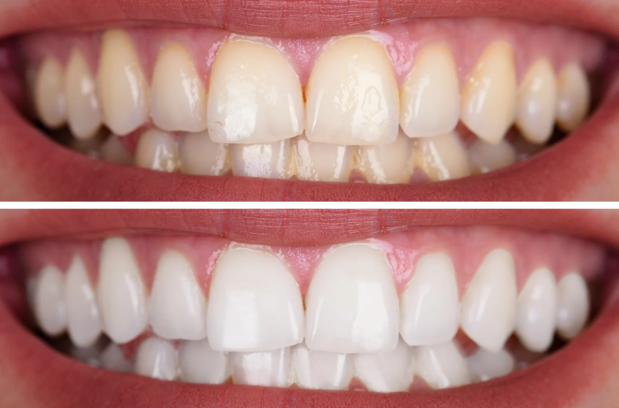 How Can You Keep Your Smile Bright After Whitening?